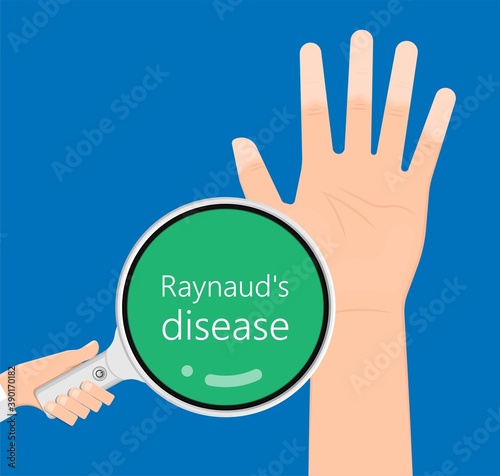 Raynaud's disease erythematosus Scleroderma buerger circulation paleness cold Injury numb vasospasm Carpal tunnel