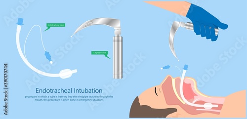Endotracheal intubation ICU care unit COVID 19 larynx throat rescue surgery mouth Tube trachea breathe ventilation deliver oxygen lungs insert sedate rest airway foreign body removal block aspiration