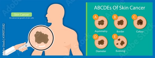 Skin cancer diagnosis dermatology screening examination UVB prevent squamous treat basal test ABCDEs rule sun