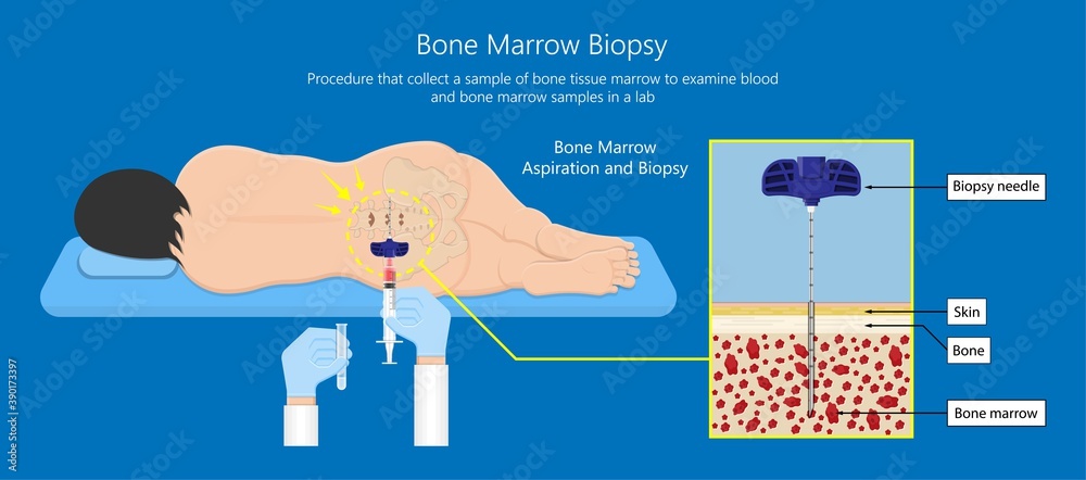 Bone biopsy medical marrow harvest stem cell transplants aspiration ...