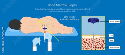 Bone biopsy medical marrow harvest stem cell transplants aspiration specimen cancer procedure sample test treatment diagnosis anemia blood cell lab disorder