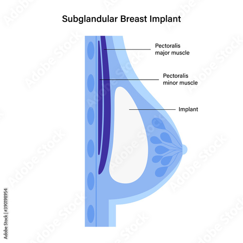 Breast Implant Concept
