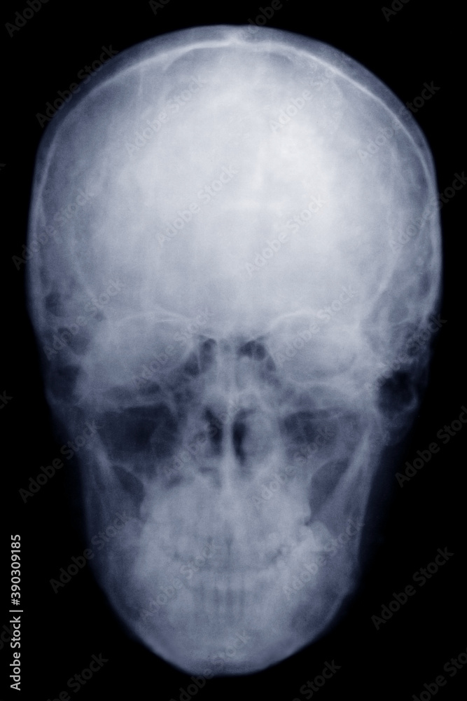 the man's skull. x-ray.
