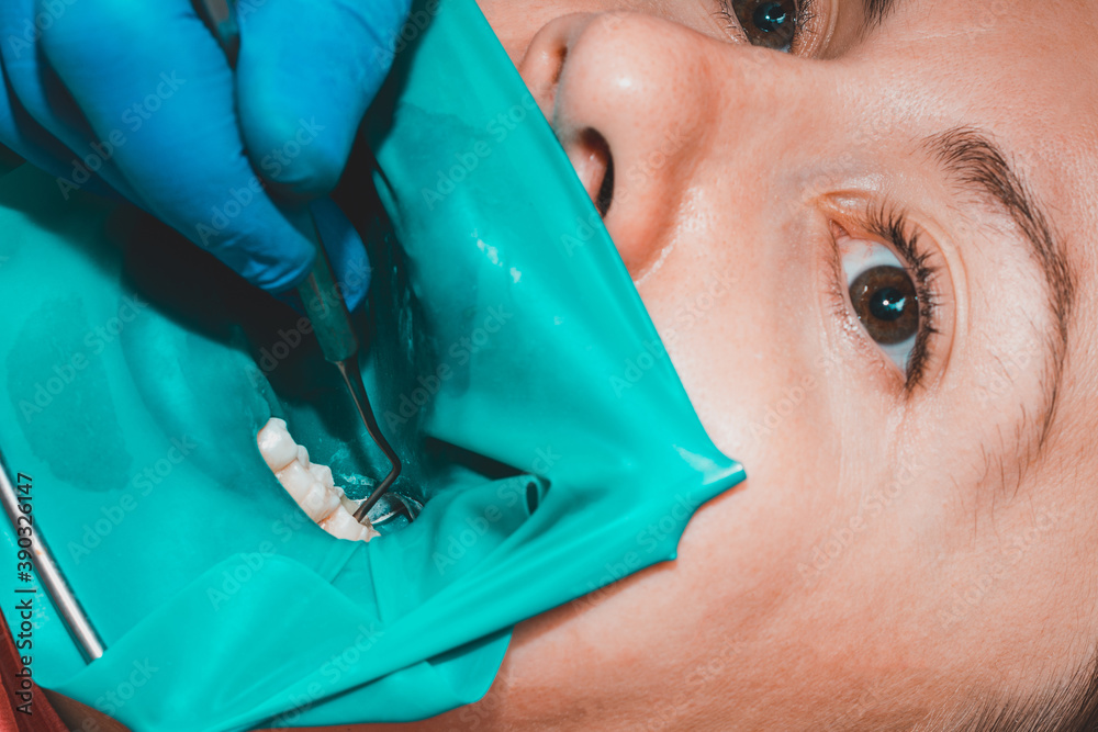 treatment of a chewing tooth, the dentist put a rubber dam, uses