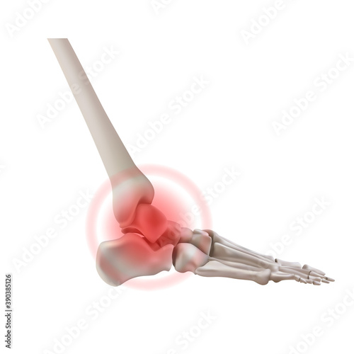 Foot bone of a person with inflamed arthritis. Vector illustration