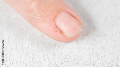 Closeup view photography of  female hand with bad long dirty nails and dry painful skin cuticle. One finger of adult woman isolated on white wooden background. Ugly long hangnail. photo