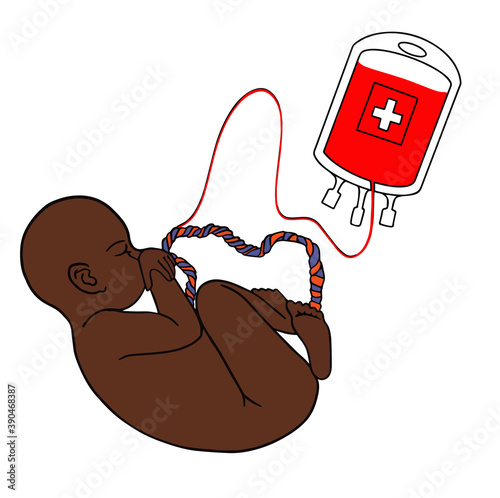 Afro babe. Taking umbilical cord blood, stem cells from an infant. Blood sampling bag. Baby in the womb. vector illustration, eps10. Hand drawn illustration for cards, posters, 