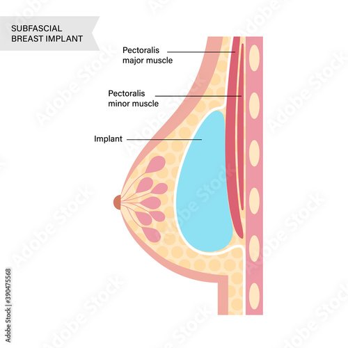 Breast Implant Concept