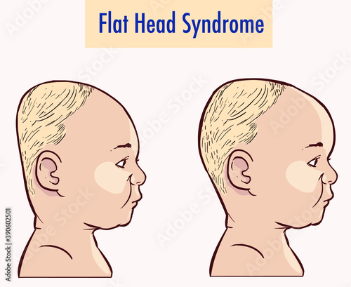 Flat Head Syndrome  Brain  vector illustration