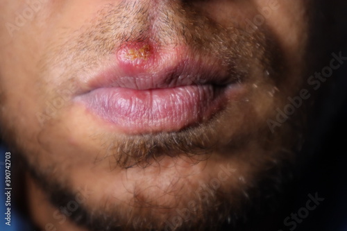 Herpes Simplex Virus (HSV) Mouth Infection. herpes simplex virus type 1. herpes simplex labialis. fever, infectious disease. Herpes labialis. cold sores. Human alphaherpesvirus 1. viral infections
