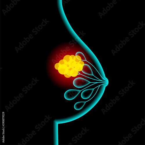 Breast disease concept