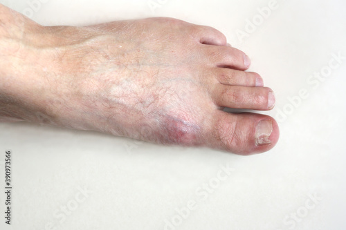 Male foot with nail fungus and inflamed gout. White background. There is room for text. 