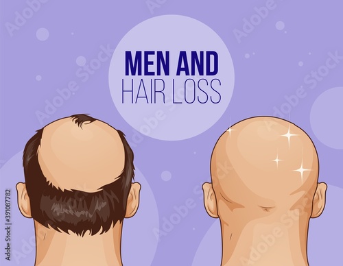Male hair loss Flat Cartoon Illustration Before after