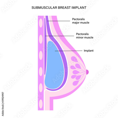 Breast Implant Concept