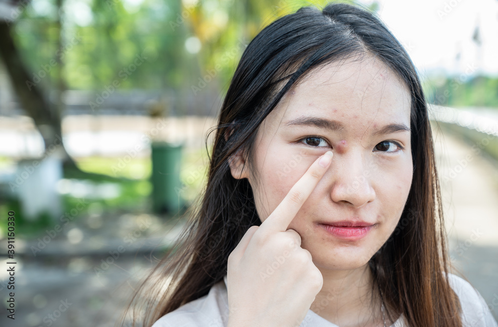 Asian woman pointing hard pimple or Elephant head acne with acne