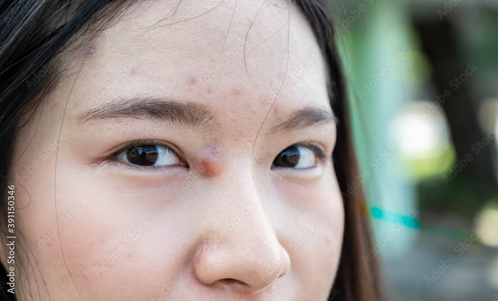 Φωτογραφία Close-up of Asian woman with pimple (or Elephant head acne) and acne inflamed on her face