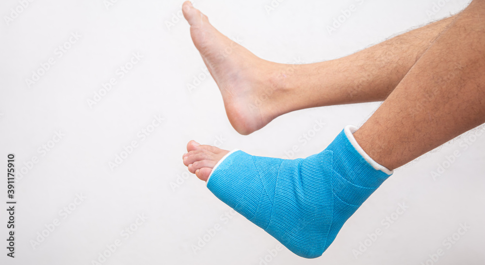 Bone fracture foot and leg on male patient close up. Bone fracture foot and leg on male patient close up.