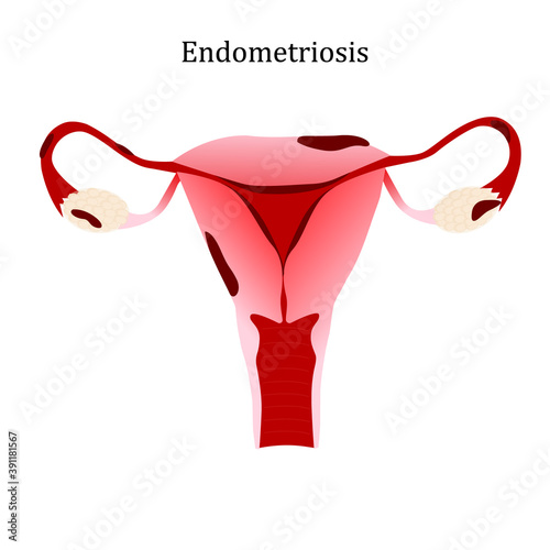 Endometriosis. Diseases of the female reproductive system. Vector illustration.
