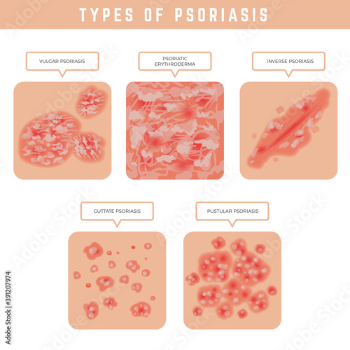 Psoriasis types. Skin problems close up medical illustrations vector set. Psoriasis problem, eczema skin disease, epidermis dermatitis