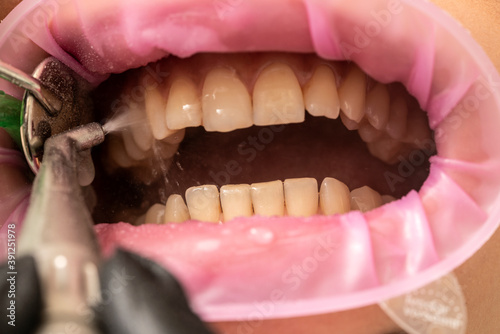 Foto Closeup of teeth sandblasting