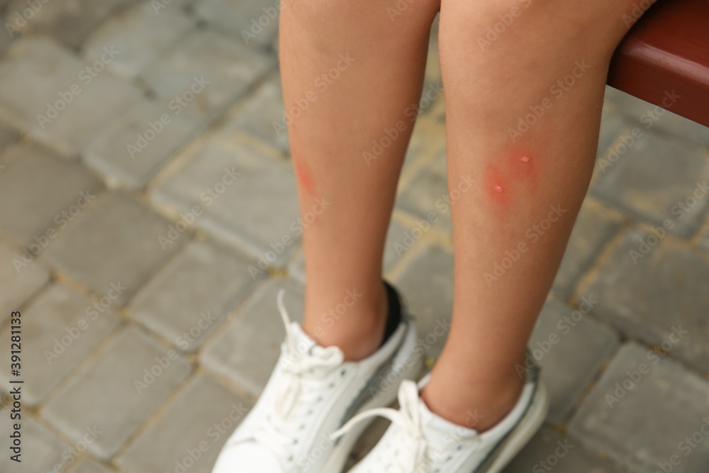 Girl with insect bites on legs outdoors, closeup