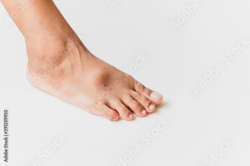 Hallux valgus, big abnormal feet bones of female feet on white background.