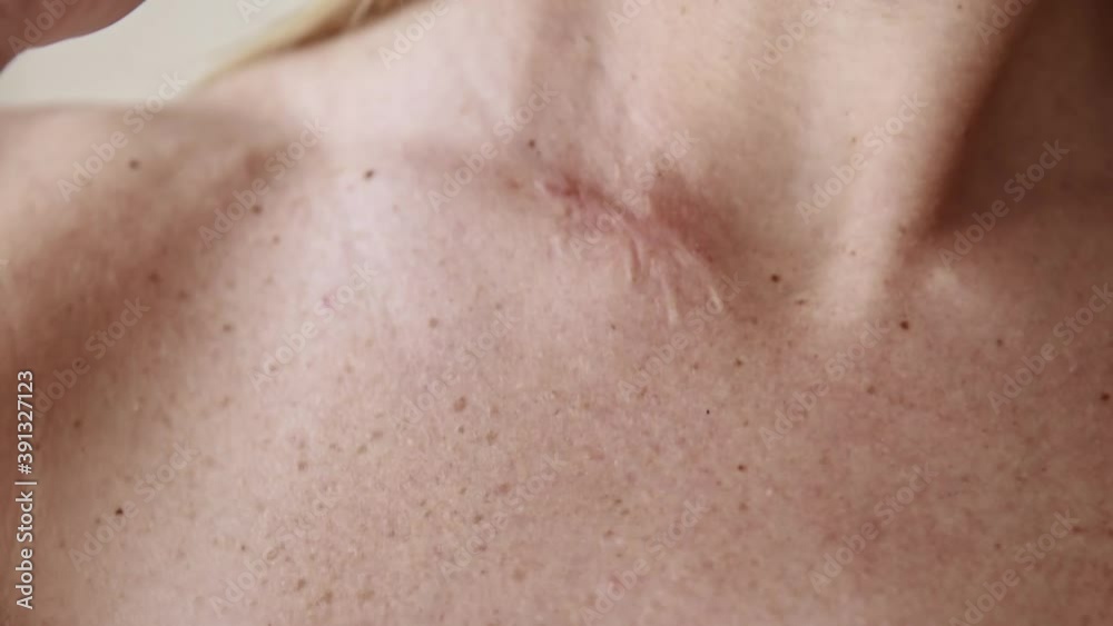 Close up surgery scar on beautiful woman neck. Close up surgery scar on beautiful woman neck.