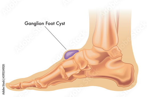 Fotografie Illustration of a ganglion cyst on the foot with annotation.