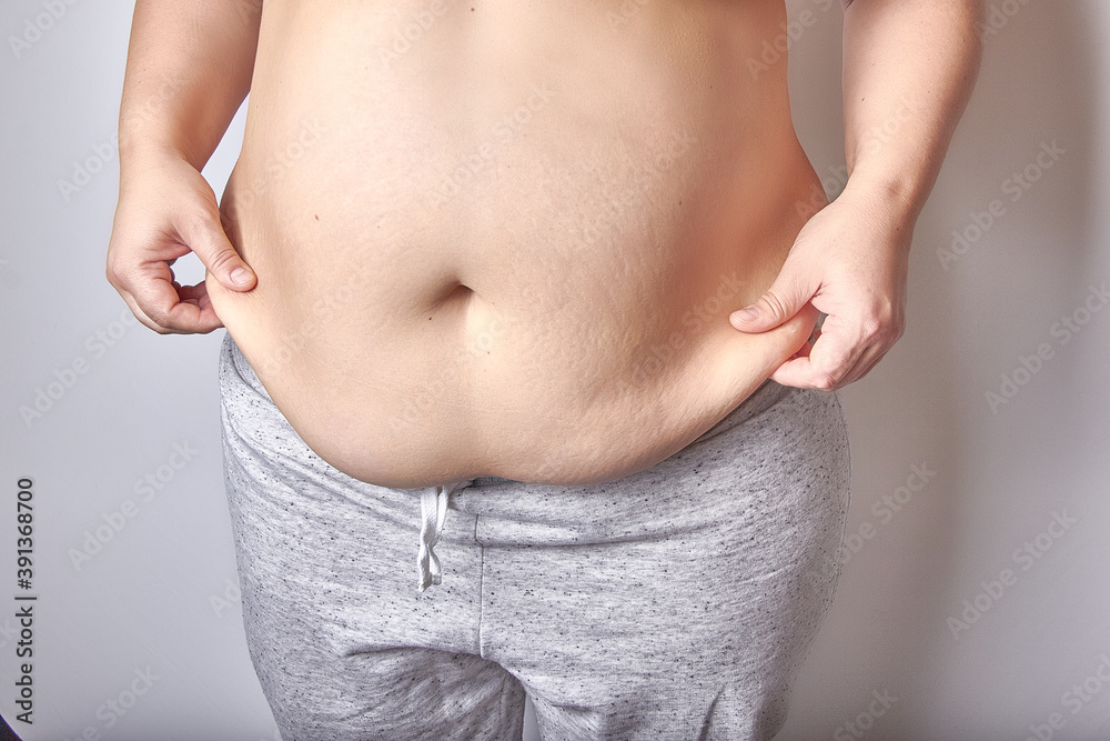 female belly after childbirth, excess fat and stretched skin female belly after childbirth, excess fat and stretched skin