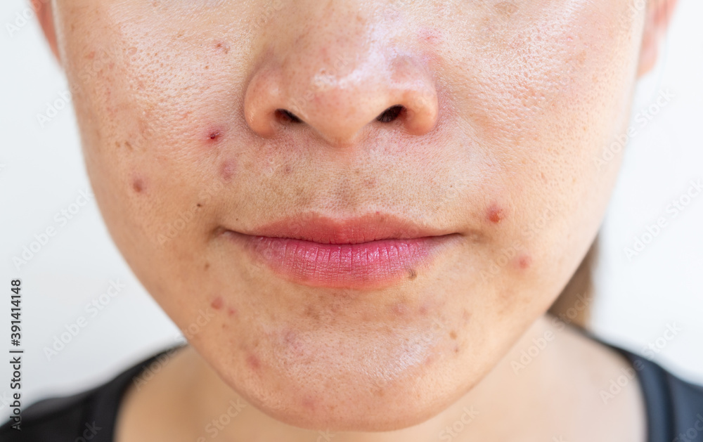 Cropped shot of woman having problems of acne inflamed on her face.  Inflamed acne consists of swelling, redness, and pores that are deeply  clogged with bacteria, oil, and dead skin cells. Stock-Foto