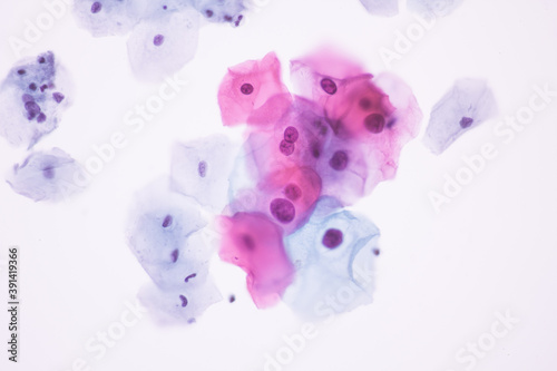 View in microscopic of Abnormal human cervix cells.Squamous epithelium cells.Superficial and intermediate epithelial cells.Cytology and pathology laboratory department.Magnification 400 X