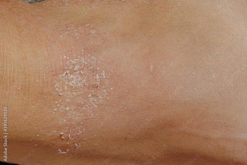 Fototapeta premium Allergic itchy skin.