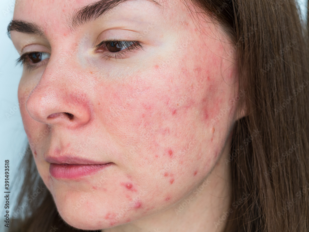 papulopustular rosacea, closeup of patient's face Stock Photo Adobe