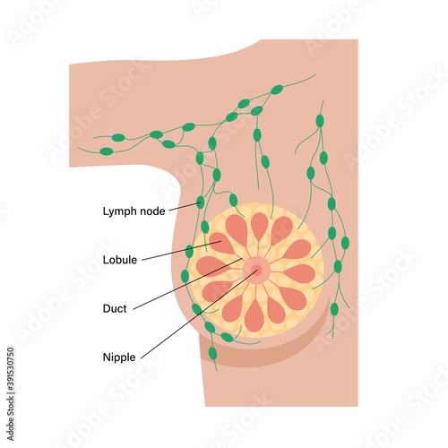 Breast disease concept