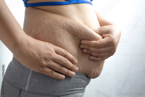 Obese woman needs weight control, she has excess fat.