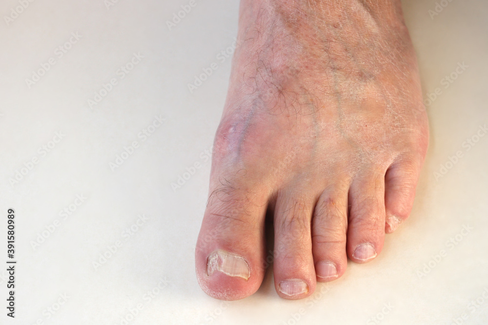 Male foot. Fungus of the nail. Damaged toenail of a man. Male foot. Fungus of the nail. Damaged toenail of a man.