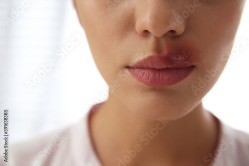 Woman with herpes on lip against light background, closeup