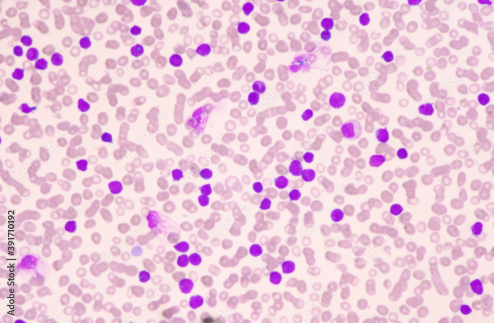 Moderate blast cell of white blood cells in blood smear.