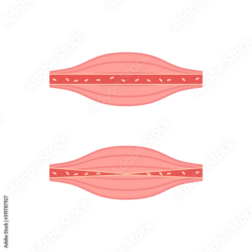 Unhealthy and healthy muscle icon set. Medical anatomy symbol. Blood flow worse concept. Painful muscle fiber structure vector illustration isolated on white.