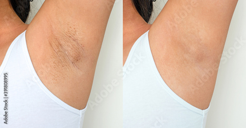 Black armpit skin in an Asian woman. Problem underarm rough chicken skin. Image before and after skincare cosmetology armpits epilation treatment concept. photo