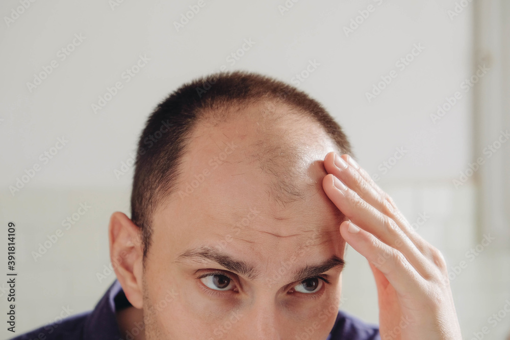 Young man looking at mirror worry about balding. Young man looking at mirror worry about balding.