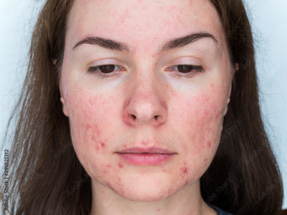 papulopustular rosacea, closeup of the patient's face the