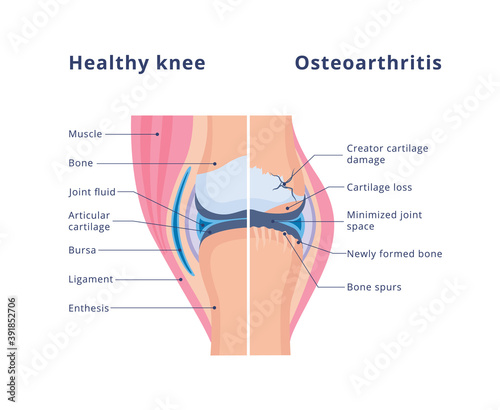 Healthy joint and damaged with osteoarthritis, flat vector illustration.