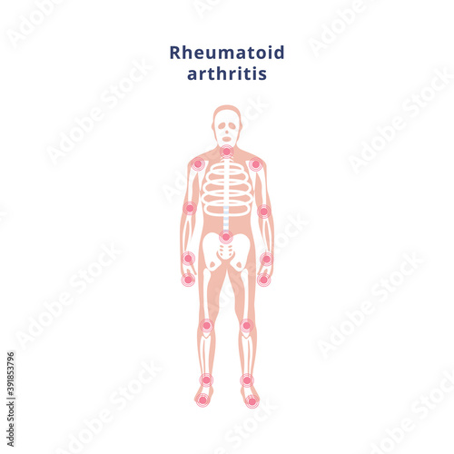 Poster with human skeleton with sources of pain disease rheumatoid arthritis