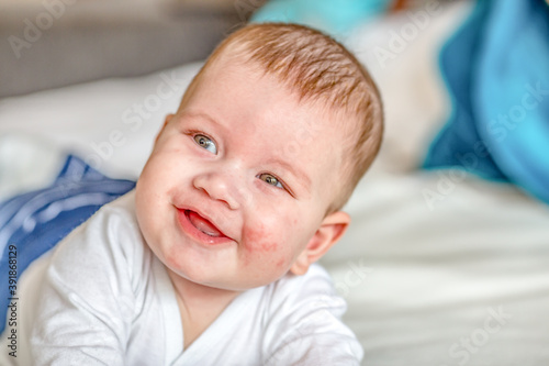 Atopic dermatitis eczema in baby.Condition that causes the skin to become red,dry,sore,itchy and cracked.Atopic eczema most often affects face in children. London England UK,Mart 30 2020