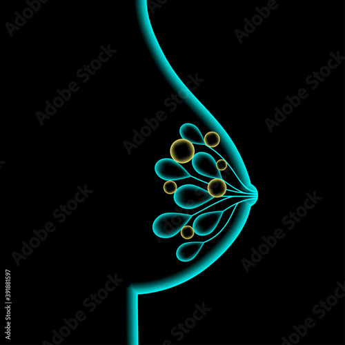 Breast disease concept