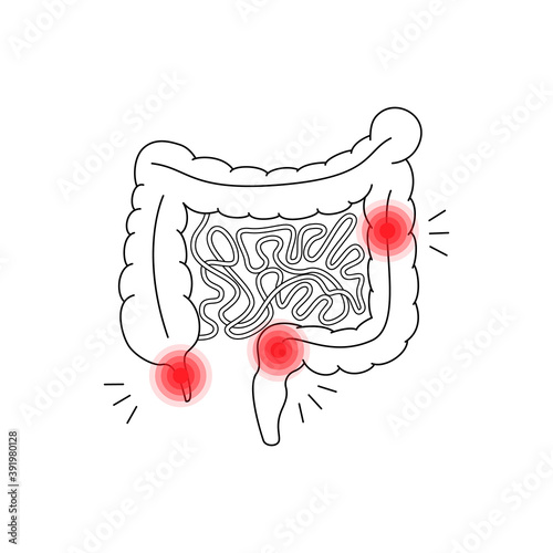 linear simple intestines and pain sign
