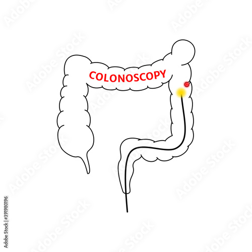 linear colonoscopy procedure sign