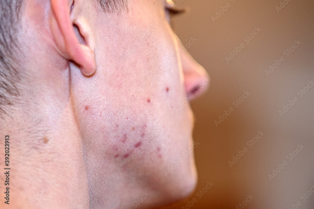 Profile of a teenager looking at his face in the mirror. Problems of the skin. Profile of a teenager looking at his face in the mirror. Problems of the skin.