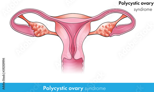Polycystic ovary: hormonal disorder of female ovaries vector design concept.